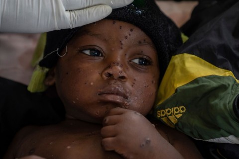 WHO gibt grünes Licht für schnelleren Mpox-Test